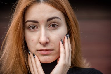 Sivilce ve yara izleri, basit bir kadın doğal portreyi kapatır makyaj ve rötuş yapmaz. Sorunlu cilt