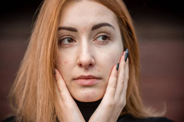 Acné Cicatrices Mujer Sencilla Cerca Retrato Natural Sin Maquillaje Retoque — Foto de Stock