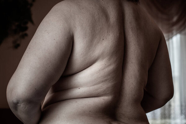 Hormonal disorder, hairy body, excess weight in women. Health problems, increased hairiness overweight concept