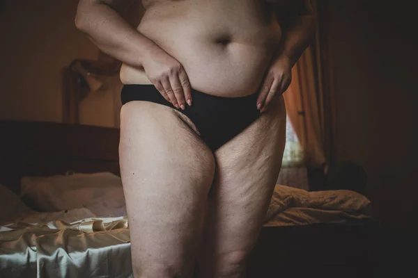 Distúrbio Hormonal Corpo Peludo Excesso Peso Mulheres Problemas Saúde Aumento — Fotografia de Stock