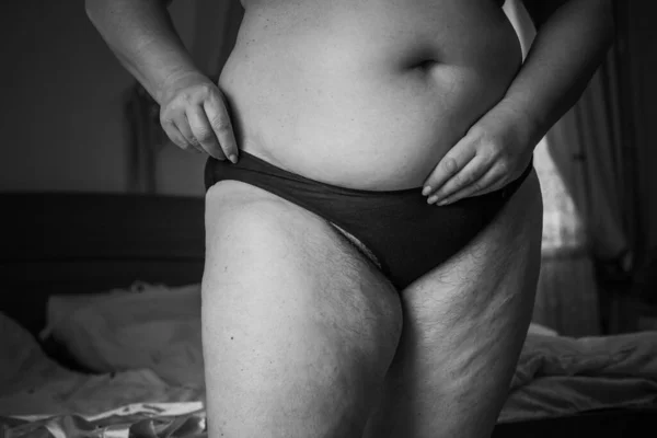 Hormonal Disorder Hairy Body Excess Weight Women Health Problems Increased — Stock Photo, Image