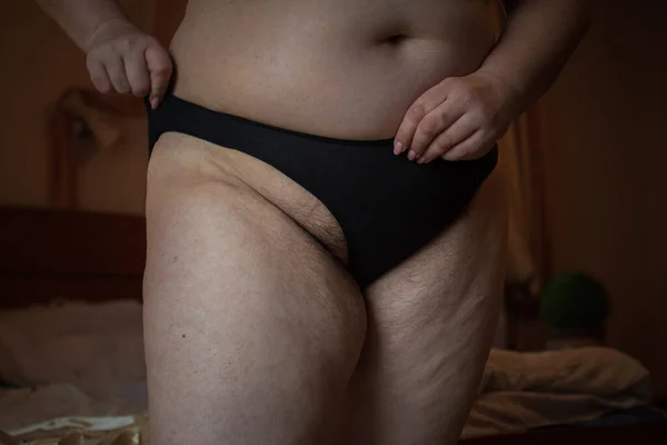 Distúrbio Hormonal Corpo Peludo Excesso Peso Mulheres Problemas Saúde Aumento — Fotografia de Stock