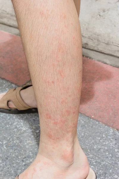 Ragazza Gamba Con Dermatite Allergica — Foto Stock