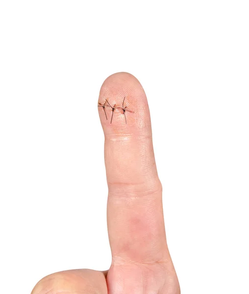 Wound Stitched Finger — Stock Photo, Image