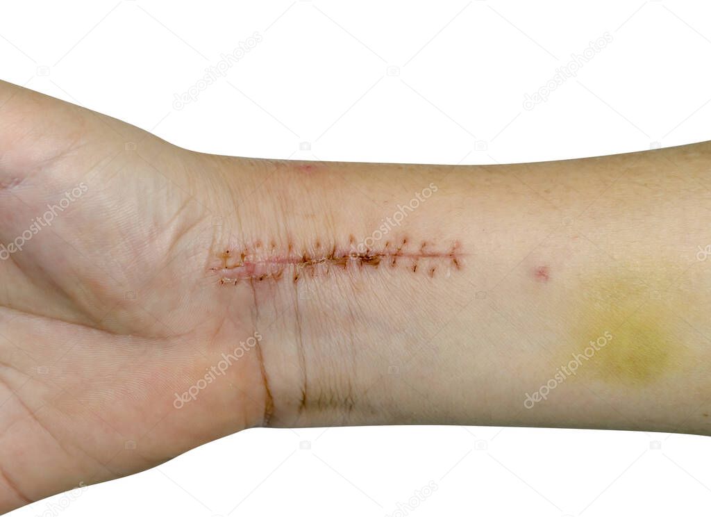closeup stitches from broken arm surgery and bruised isolated on white background with clipping path