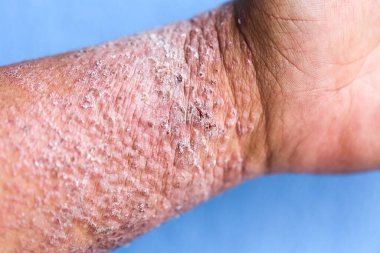Atopik egzama olarak da bilinen dermatit (AD) cilt iltihabının bir türüdür (dermatit).).