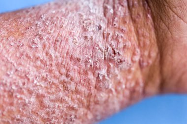 Atopik egzama olarak da bilinen dermatit (AD) cilt iltihabının bir türüdür (dermatit).).