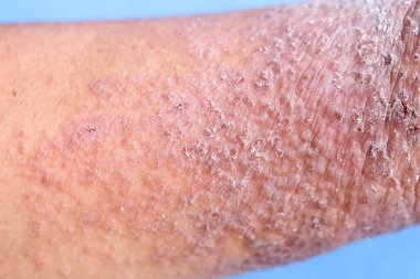Atopik egzama olarak da bilinen dermatit (AD) cilt iltihabının bir türüdür (dermatit).).