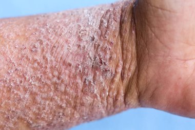 Atopik egzama olarak da bilinen dermatit (AD) cilt iltihabının bir türüdür (dermatit).).
