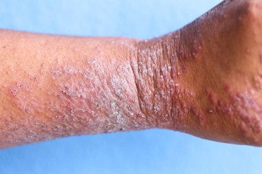 Atopik egzama olarak da bilinen dermatit (AD) cilt iltihabının bir türüdür (dermatit).).