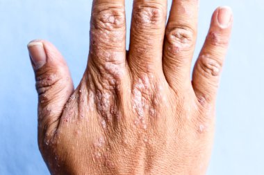 Atopik egzama olarak da bilinen dermatit (AD) cilt iltihabının bir türüdür (dermatit).).