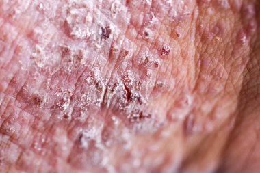 Atopik egzama olarak da bilinen dermatit (AD) cilt iltihabının bir türüdür (dermatit).).