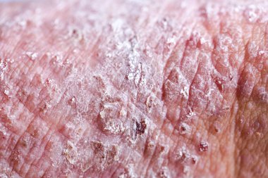Atopik egzama olarak da bilinen dermatit (AD) cilt iltihabının bir türüdür (dermatit).).