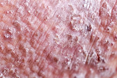 Atopik egzama olarak da bilinen dermatit (AD) cilt iltihabının bir türüdür (dermatit).).