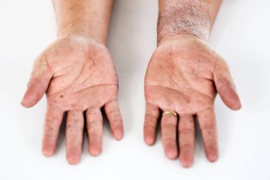 Atopik egzama olarak da bilinen dermatit (AD) cilt iltihabının bir türüdür (dermatit).).