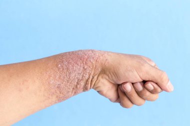 Atopik egzama olarak da bilinen dermatit (AD) cilt iltihabının bir türüdür (dermatit).).