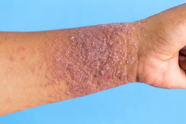 Atopik egzama olarak da bilinen dermatit (AD) cilt iltihabının bir türüdür (dermatit).).