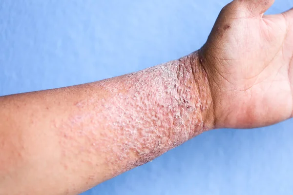 Atopic Dermatitis Also Known Atopic Eczema Type Inflammation Skin Dermatitis — Stock Photo, Image