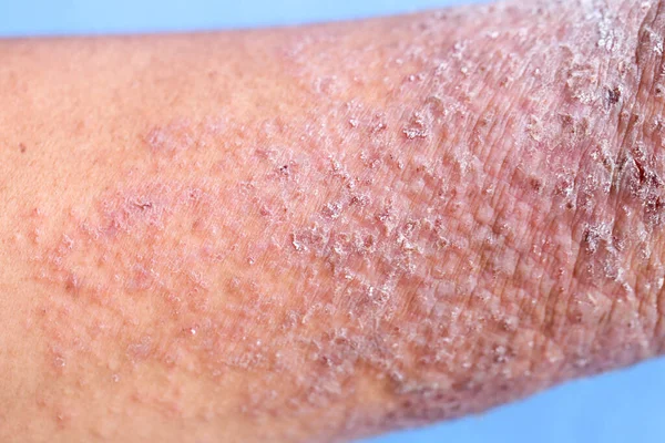 Atopic Dermatitis Also Known Atopic Eczema Type Inflammation Skin Dermatitis — Stock Photo, Image