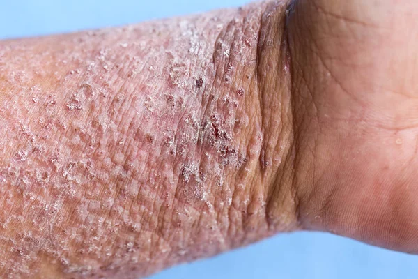 异位性皮炎 Atopic Dermatitis 又称特发性湿疹 Atopic Eczema 是一种皮肤炎症 — 图库照片
