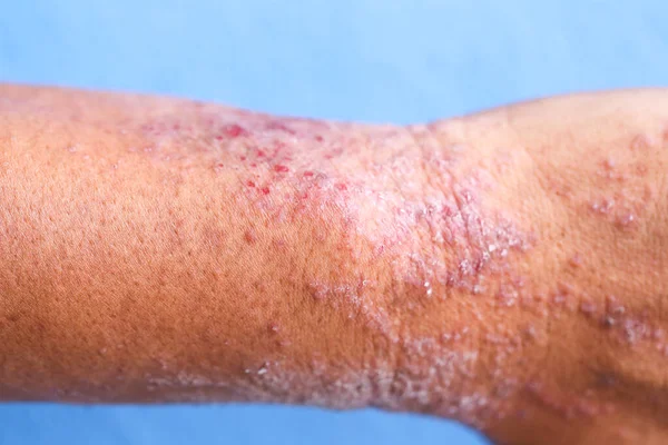 Dermatite Atópica Também Conhecida Como Eczema Atópico Tipo Inflamação Pele — Fotografia de Stock