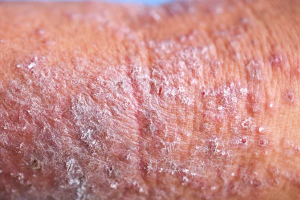 Dermatite Atópica Também Conhecida Como Eczema Atópico Tipo Inflamação Pele — Fotografia de Stock