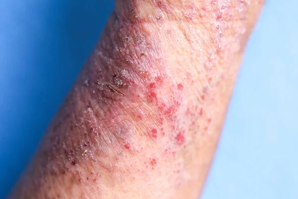 Dermatite Atópica Também Conhecida Como Eczema Atópico Tipo Inflamação Pele — Fotografia de Stock