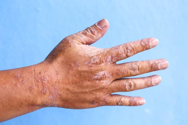 Dermatite Atópica Também Conhecida Como Eczema Atópico Tipo Inflamação Pele — Fotografia de Stock