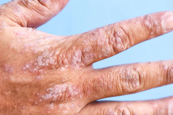 Dermatite Atópica Também Conhecida Como Eczema Atópico Tipo Inflamação Pele — Fotografia de Stock