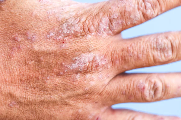 Dermatite Atópica Também Conhecida Como Eczema Atópico Tipo Inflamação Pele — Fotografia de Stock