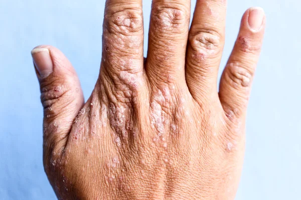 Atopisk Dermatitis Også Kendt Som Atopisk Eksem Type Betændelse Huden - Stock-foto