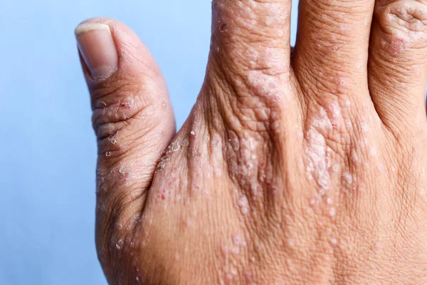 Dermatite Atópica Também Conhecida Como Eczema Atópico Tipo Inflamação Pele — Fotografia de Stock