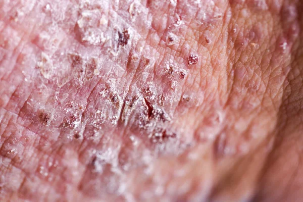 Atopická Dermatitida Také Známý Jako Atopický Ekzém Typ Zánětu Kůže — Stock fotografie