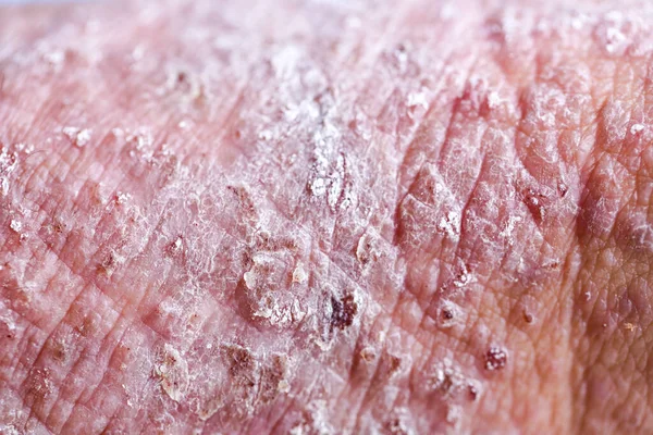 Dermatite Atópica Também Conhecida Como Eczema Atópico Tipo Inflamação Pele — Fotografia de Stock