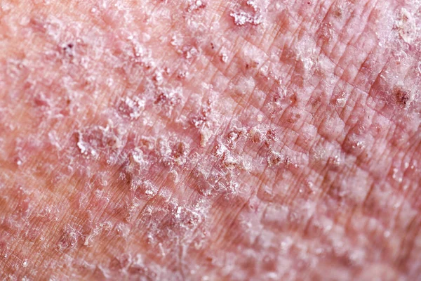 Dermatitis Atópica También Conocida Como Eccema Atópico Tipo Inflamación Piel —  Fotos de Stock