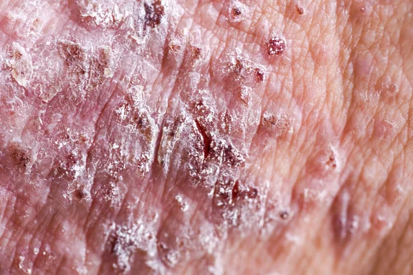 Dermatitis Atópica También Conocida Como Eccema Atópico Tipo Inflamación Piel — Foto de Stock