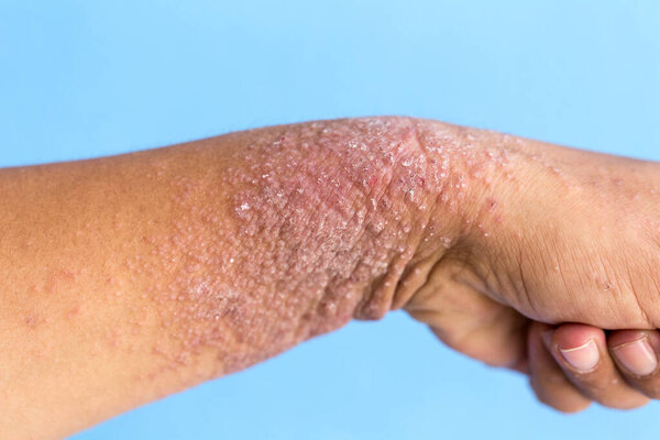 Atopic dermatitis (AD), also known as atopic eczema, is a type of inflammation of the skin (dermatitis).