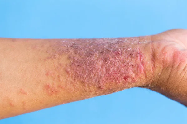 Dermatita Atopică Cunoscută Sub Numele Eczeme Atopice Este Tip Inflamație — Fotografie, imagine de stoc