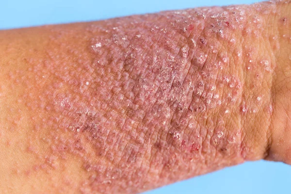 Dermatite Atópica Também Conhecida Como Eczema Atópico Tipo Inflamação Pele — Fotografia de Stock