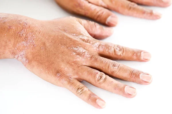 异位性皮炎 Atopic Dermatitis 又称特发性湿疹 Atopic Eczema 是一种皮肤炎症 图库照片