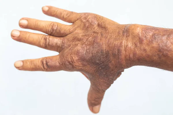 Físico Dermatite Atópica Também Conhecido Como Eczema Atópico Tipo Inflamação — Fotografia de Stock