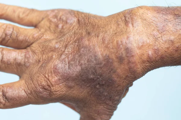 Fyzické Atopická Dermatitida Také Známý Jako Atopický Ekzém Typ Zánětu — Stock fotografie
