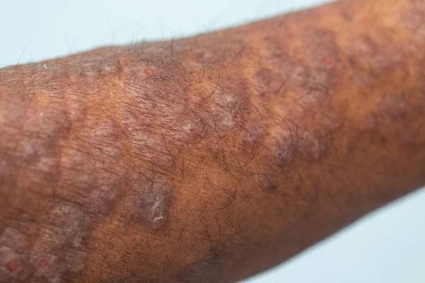Físico Dermatitis Atópica También Conocida Como Eccema Atópico Tipo Inflamación — Foto de Stock