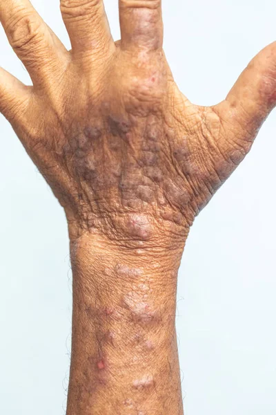 Physical Atopic Dermatitis Also Known Atopic Eczema Type Inflammation Skin — Stock Photo, Image