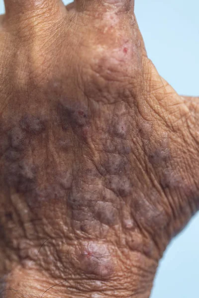 Fyzické Atopická Dermatitida Také Známý Jako Atopický Ekzém Typ Zánětu — Stock fotografie