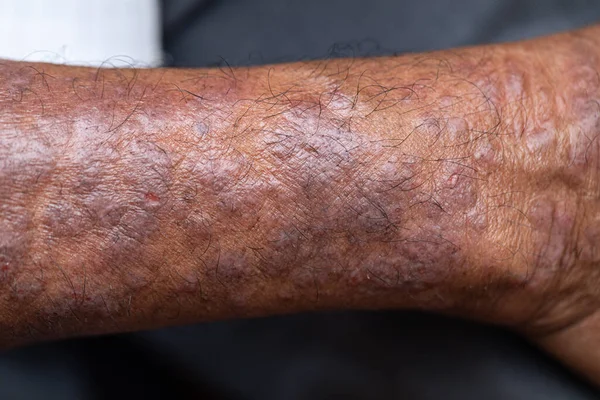 アトピー性皮膚炎 アトピー性皮膚炎とも呼ばれ 皮膚の炎症の一種です — ストック写真