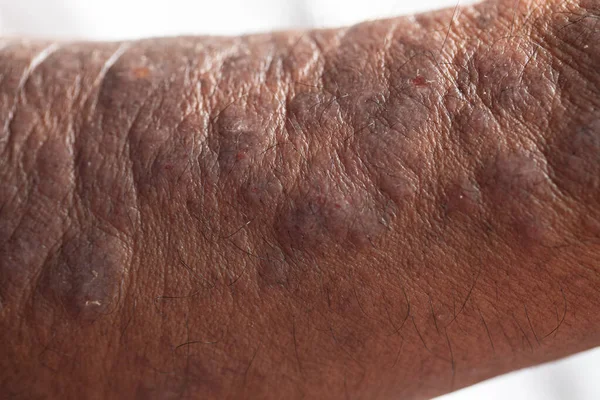 Físico Dermatite Atópica Também Conhecido Como Eczema Atópico Tipo Inflamação — Fotografia de Stock