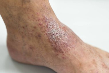 Atopik deri iltihabı (Atopedik egzama), bir tür deri iltihabı (dermatit).).