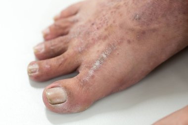Atopik deri iltihabı (Atopedik egzama), bir tür deri iltihabı (dermatit).).