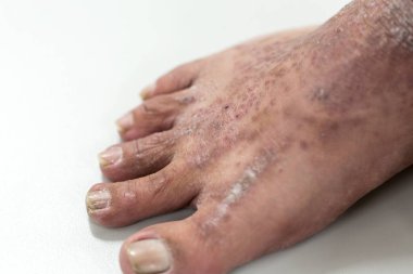 Atopik deri iltihabı (Atopedik egzama), bir tür deri iltihabı (dermatit).).